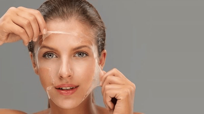 لایه برداری شیمیایی (Chemical Peeling)